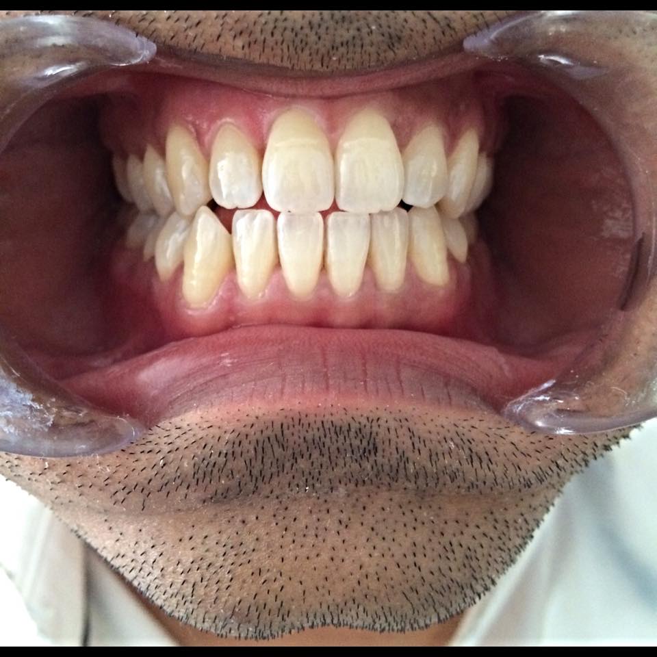 Teeth Whitening Treatment In Dubai