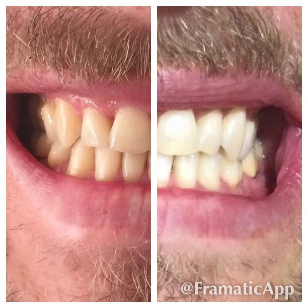 Teeth Whitening Treatment Result