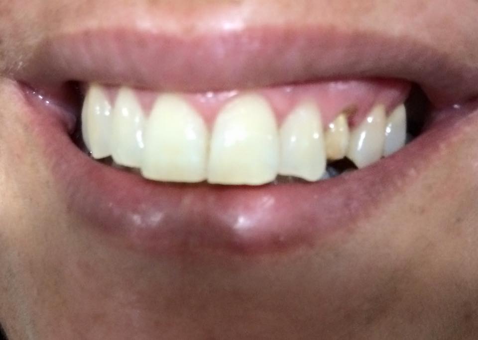 dental restorations treatment in al barsha