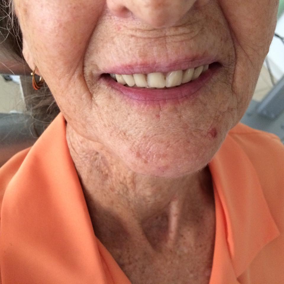 after dental implant results