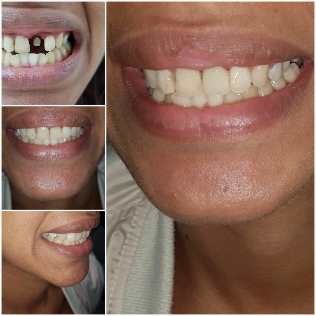 Dental Restorations Treatment