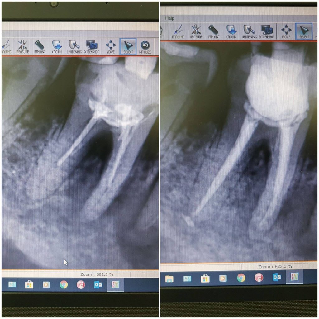root canal results