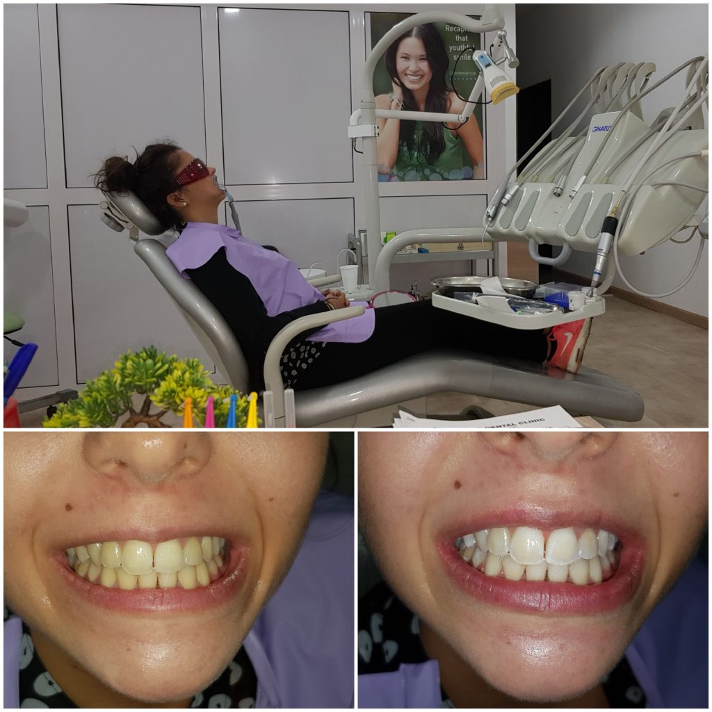 Teeth Whitening Clinic In Dubai