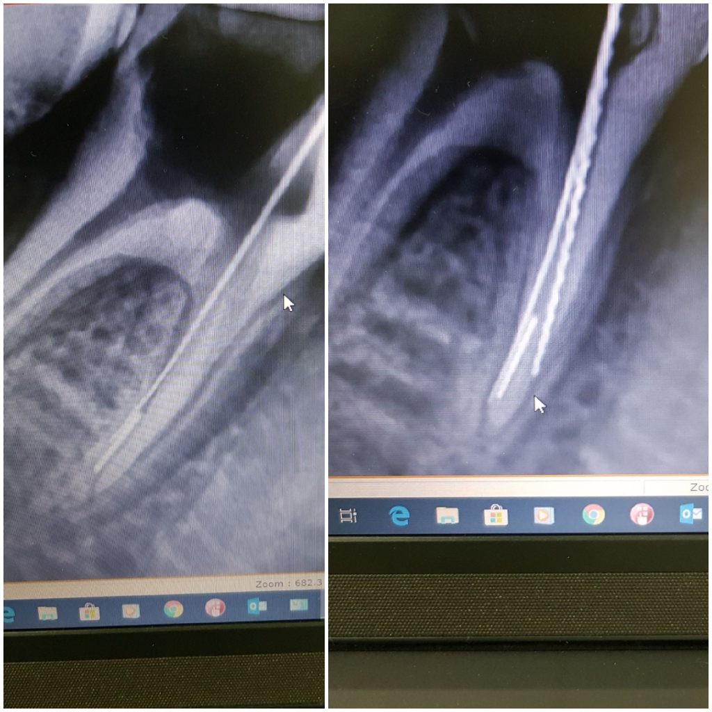 bypass in distal canal scaled
