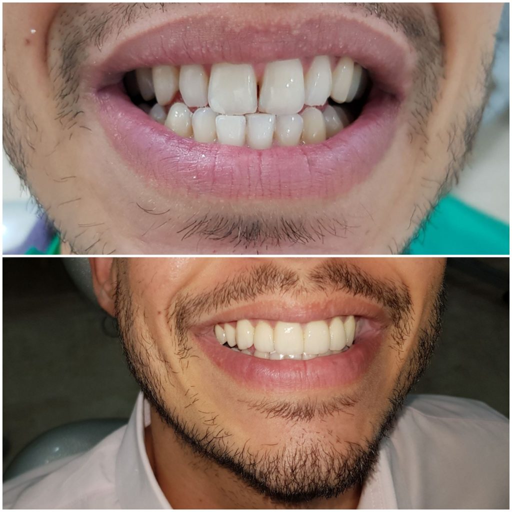 Smile of porcelain veeners treatment