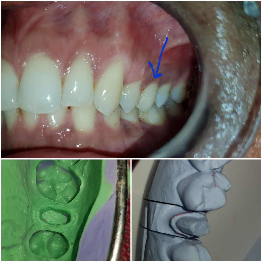 Emax Crown dental restorations treatment