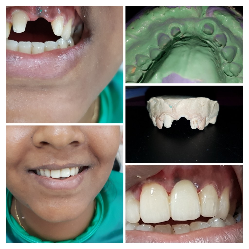 Dental Restorations Treatment in Dubai