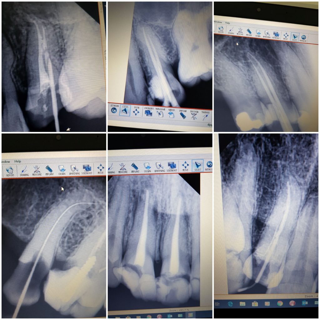root canal scaled