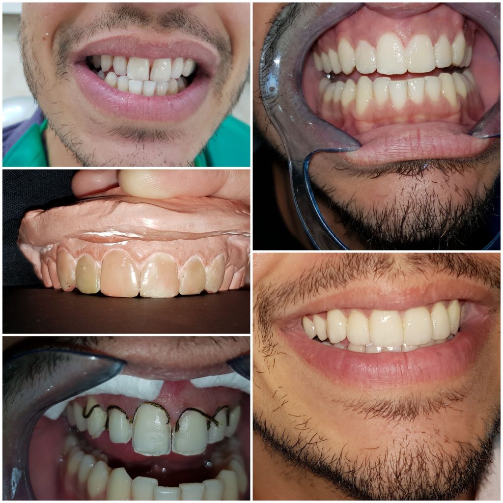 Dental Veeners treatment in dubai