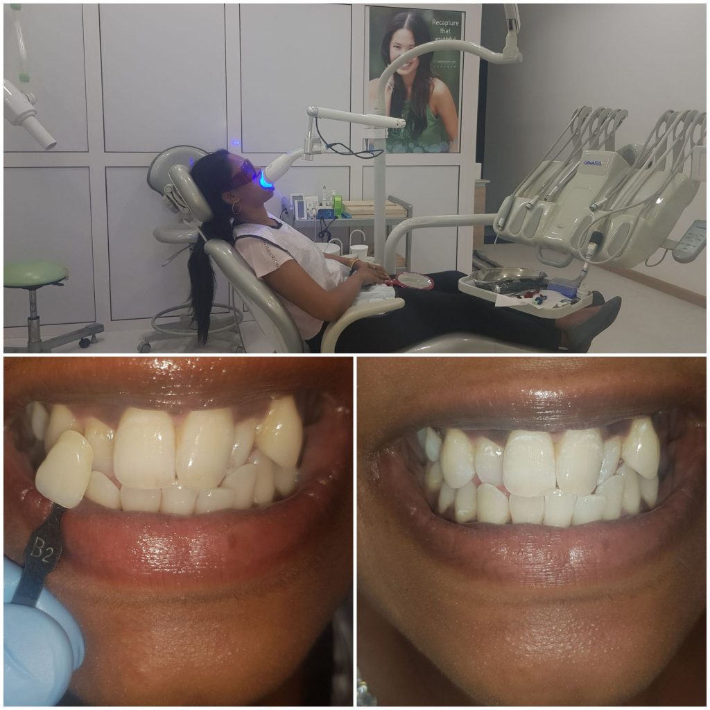 Teeth Whitening Treatment In Al Barsha Dubai
