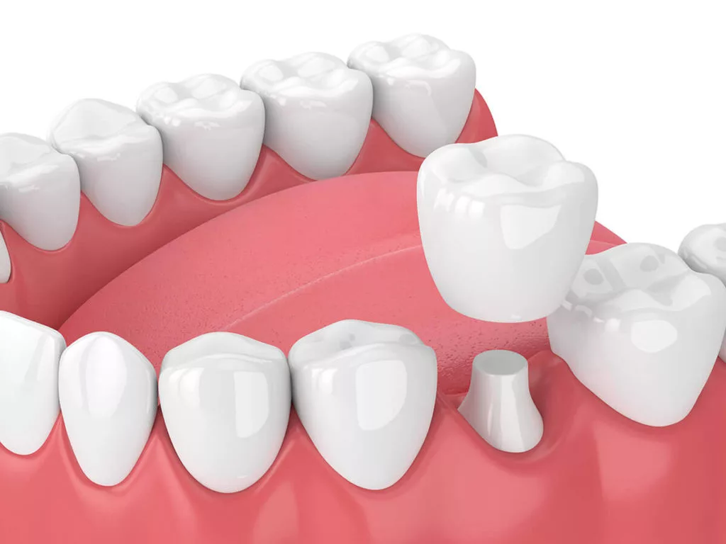 Dental Crown and Bridges Treatment in Al Barsha Dubai