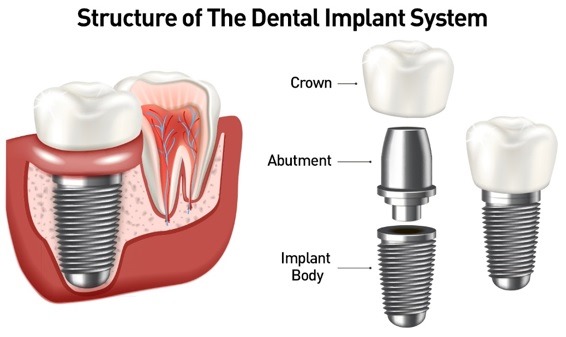 Structure of dental implant