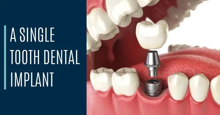 Single tooth dental implant